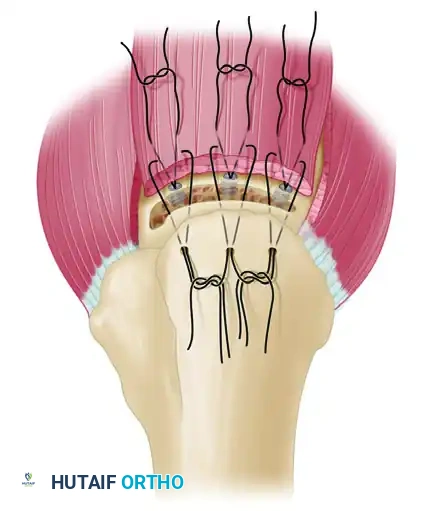 Coracohumeral Release