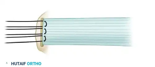 Tendon Fixation