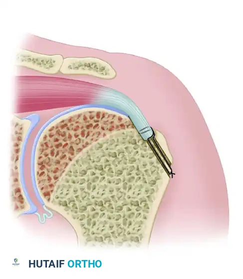 McLaughlin Technique