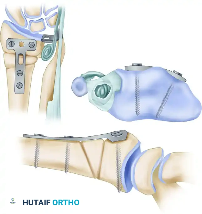 OPENING WEDGE METAPHYSEAL OSTEOTOMY WITH BONE GRAFTING AND INTERNAL FIXATION WITH PLATE AND SCREWS Surgical Diagram