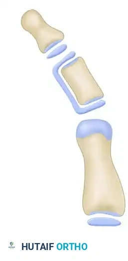 OPENING WEDGE OSTEOTOMY OF THE TERMINAL PHALANX Surgical Diagram