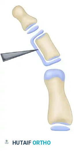 OPENING WEDGE OSTEOTOMY OF THE TERMINAL PHALANX Surgical Diagram