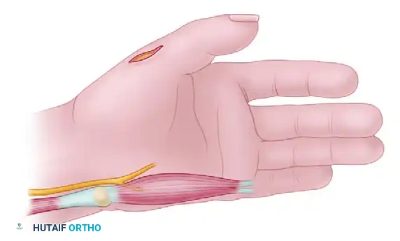 Comprehensive Management of Congenital Hand Anomalies: Abductor Digiti Minimi Opponensplasty and Central Deficiencies