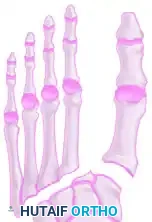 FIGURE 88-63 Cross section of foot showing release of four fascial compartments of forefoot.