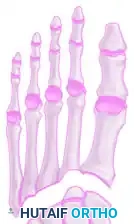 FIGURE 88-63 Cross section of foot showing release of four fascial compartments of forefoot.