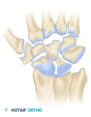 Osteoarthritis of the Wrist: SLAC Wrist Pathoanatomy and Surgical Management