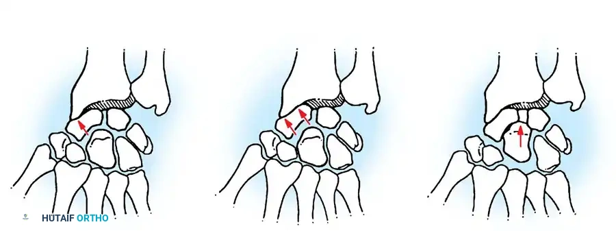 Osteoarthritis of the Wrist: SLAC Management