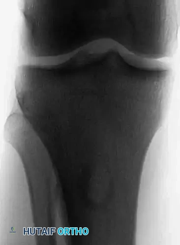 CMF Proximal Tibia AP
