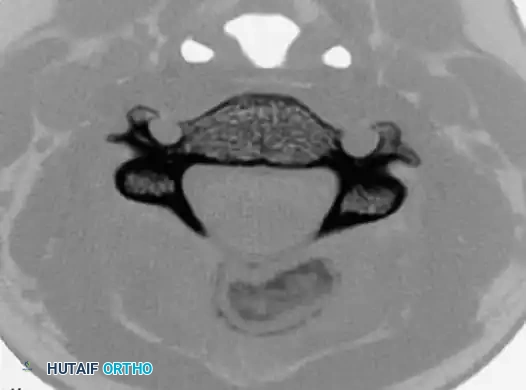 Osteoblastoma Cervical Spine CT Axial