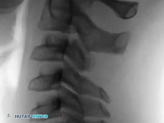 Osteoblastoma Post-op Lateral