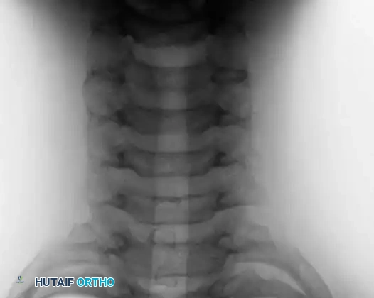 Osteoblastoma Post-op AP