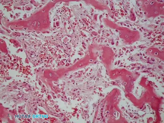 Osteoblastoma Distal Tibia