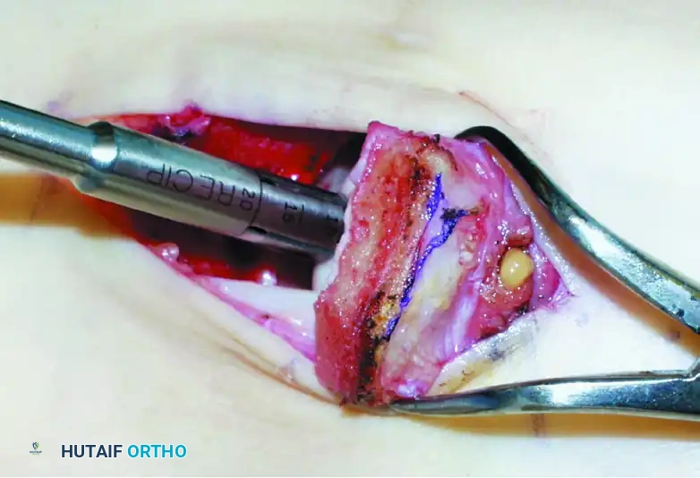 OSTEOCHONDRAL AUTOGRAFT/ ALLOGRAFT TRANSPLANTATION Surgical Diagram