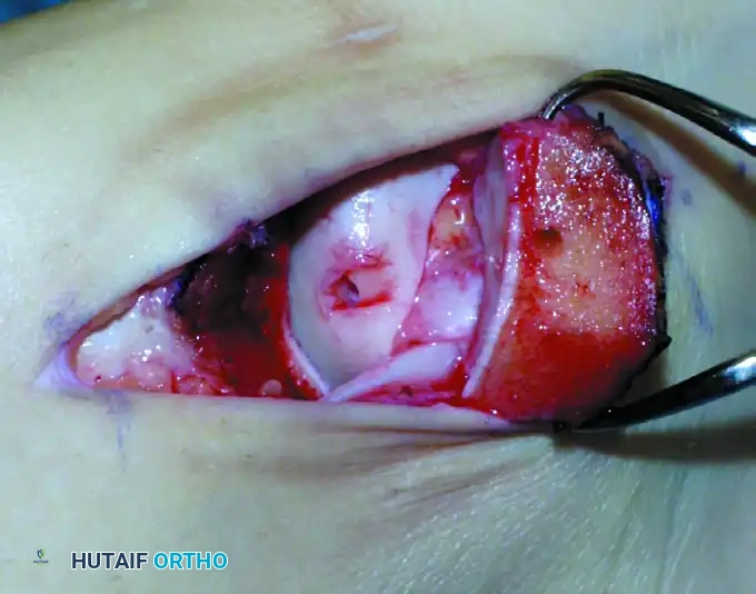 OSTEOCHONDRAL AUTOGRAFT/ ALLOGRAFT TRANSPLANTATION Surgical Diagram