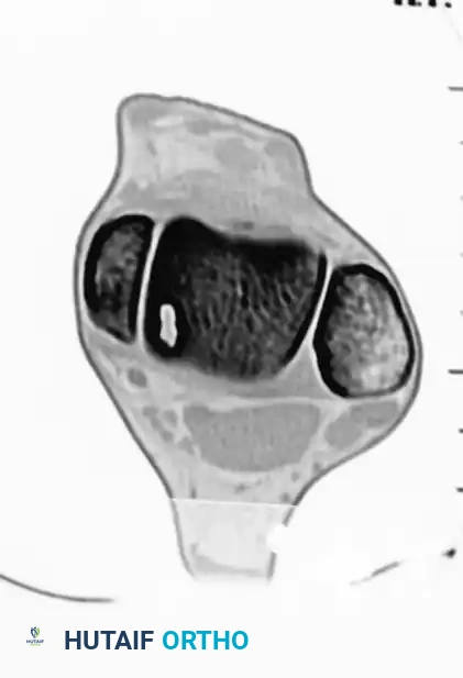 OSTEOCHONDRAL AUTOGRAFT/ ALLOGRAFT TRANSPLANTATION Surgical Diagram