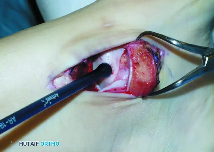 OSTEOCHONDRAL AUTOGRAFT/ ALLOGRAFT TRANSPLANTATION Surgical Diagram