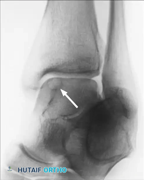 Osteochondral Autograft and Allograft Transplantation of the Talus: A Master Surgical Guide