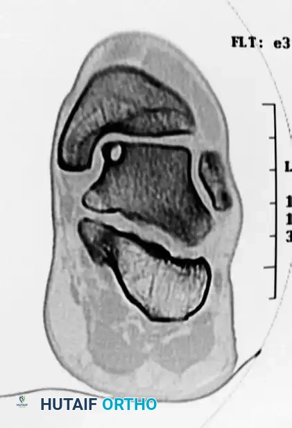 OSTEOCHONDRAL AUTOGRAFT/ ALLOGRAFT TRANSPLANTATION Surgical Diagram