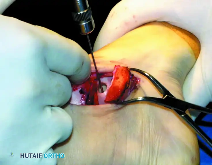 OSTEOCHONDRAL AUTOGRAFT/ ALLOGRAFT TRANSPLANTATION Surgical Diagram