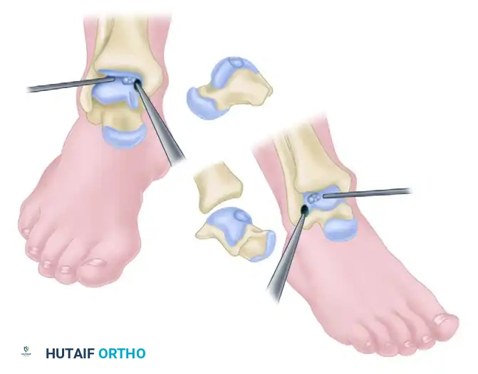 OSTEOCHONDRAL AUTOGRAFT/ ALLOGRAFT TRANSPLANTATION Surgical Diagram