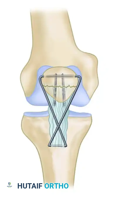 Osteochondral Fractures of the Knee: Comprehensive Principles and Surgical Management