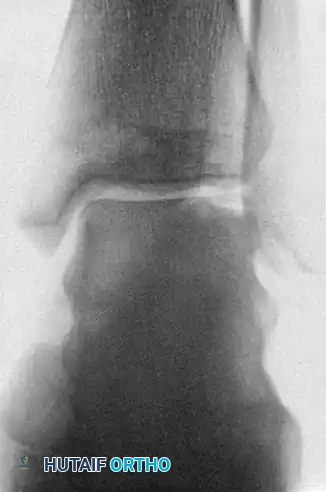 Osteochondral Lesions of the Talus: Surgical Management