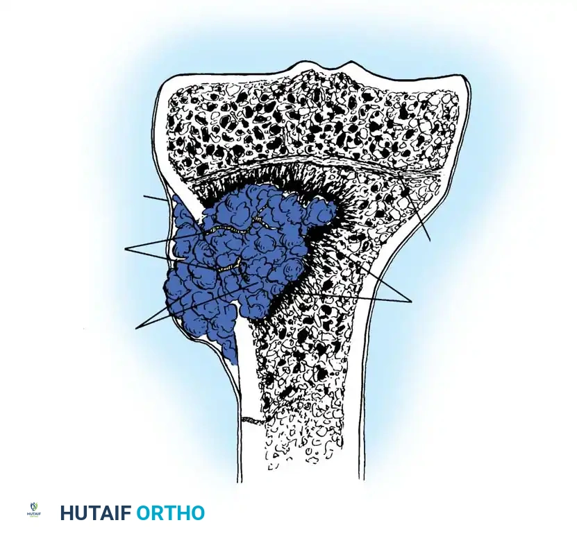Osteomyelitis: Comprehensive Surgical Management and Classification