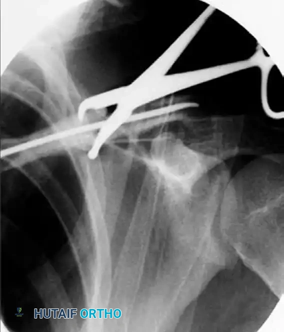 Insertion of elastic nail under fluoroscopic control