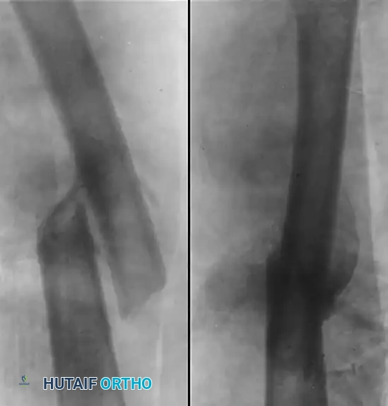 Osteotomy for Femoral Malunion: Comprehensive Surgical Principles