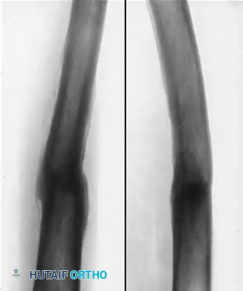 OSTEOTOMY FOR FEMORAL MALUNION Surgical Diagram