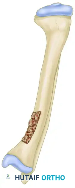 Osteotomy for Femoral Malunion in Children: Comprehensive Surgical Guide