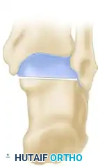 OSTEOTOMY OF THE CALCANEUS Surgical Diagram