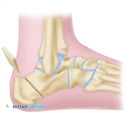 OSTEOTOMY OF THE CALCANEUS Surgical Diagram
