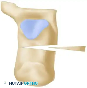 OSTEOTOMY OF THE CALCANEUS Surgical Diagram