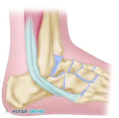 OSTEOTOMY OF THE CALCANEUS Surgical Diagram