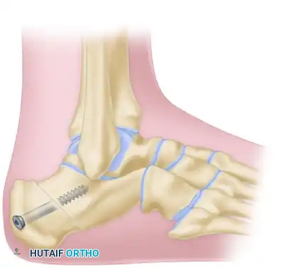 OSTEOTOMY OF THE CALCANEUS Surgical Diagram