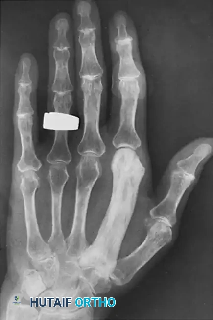 PAGET DISEASE Surgical Diagram