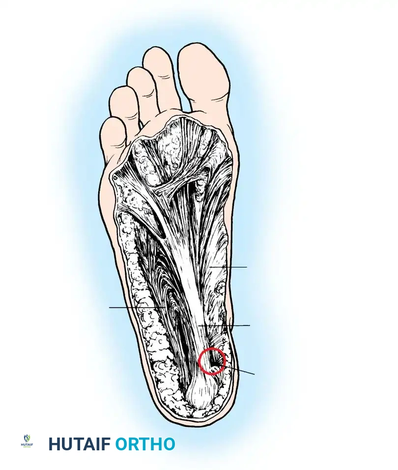 Lateral component of plantar aponeurosis