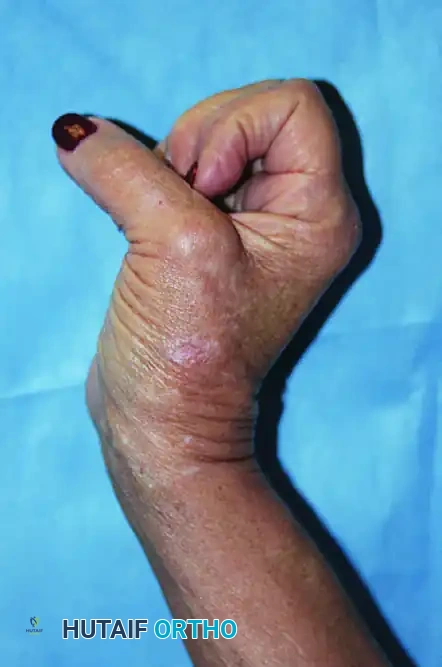 Paralytic Hand: Principles of Tendon Transfer and Surgical Reconstruction