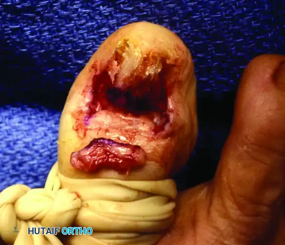 PARTIAL NAIL FOLD AND NAIL MATRIX REMOVAL Surgical Diagram