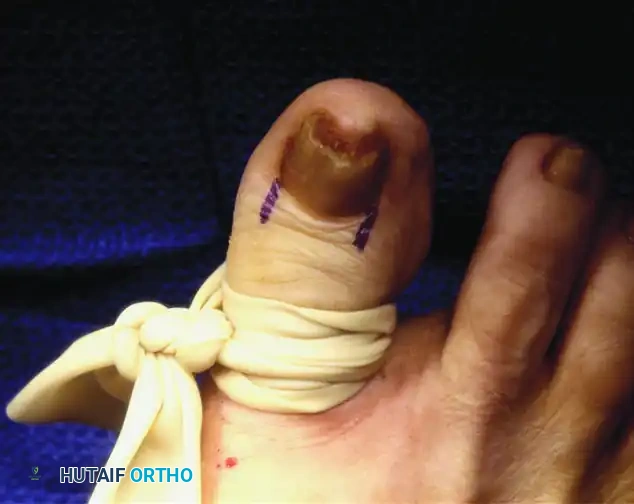 PARTIAL NAIL FOLD AND NAIL MATRIX REMOVAL Surgical Diagram