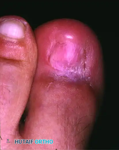 PARTIAL NAIL FOLD AND NAIL MATRIX REMOVAL Surgical Diagram