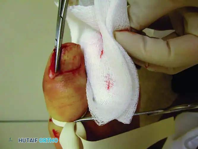 PARTIAL NAIL PLATE AND MATRIX REMOVAL Surgical Diagram