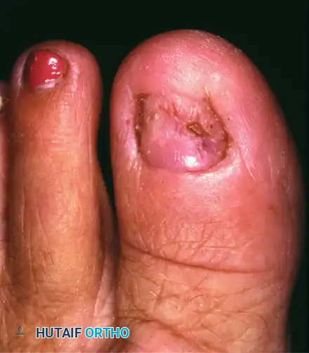 PARTIAL NAIL PLATE AND MATRIX REMOVAL Surgical Diagram