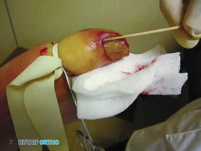 PARTIAL NAIL PLATE AND MATRIX REMOVAL Surgical Diagram