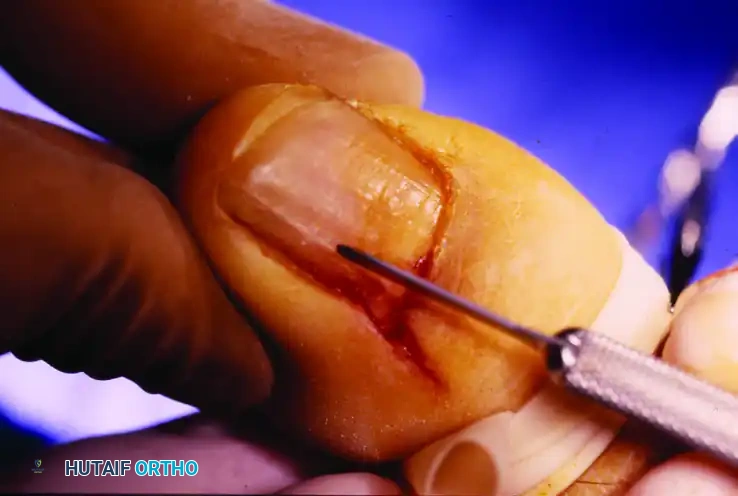 PARTIAL NAIL PLATE AND MATRIX REMOVAL Surgical Diagram