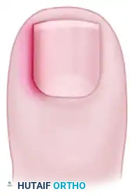 PARTIAL NAIL PLATE AND MATRIX REMOVAL Surgical Diagram