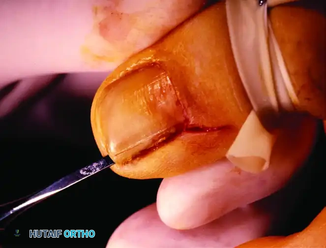 PARTIAL NAIL PLATE AND MATRIX REMOVAL Surgical Diagram