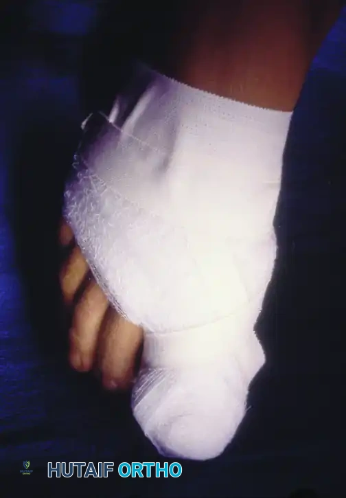 PARTIAL NAIL PLATE AND MATRIX REMOVAL Surgical Diagram