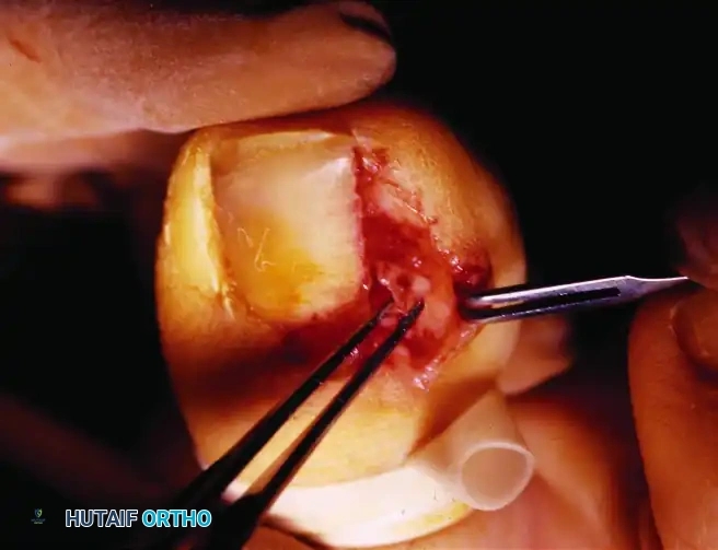 PARTIAL NAIL PLATE AND MATRIX REMOVAL Surgical Diagram